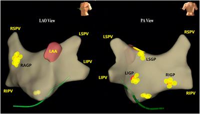 Selection of patients with symptomatic vagal-induced sinus node dysfunction: Who will be the best candidate for cardioneuroablation?